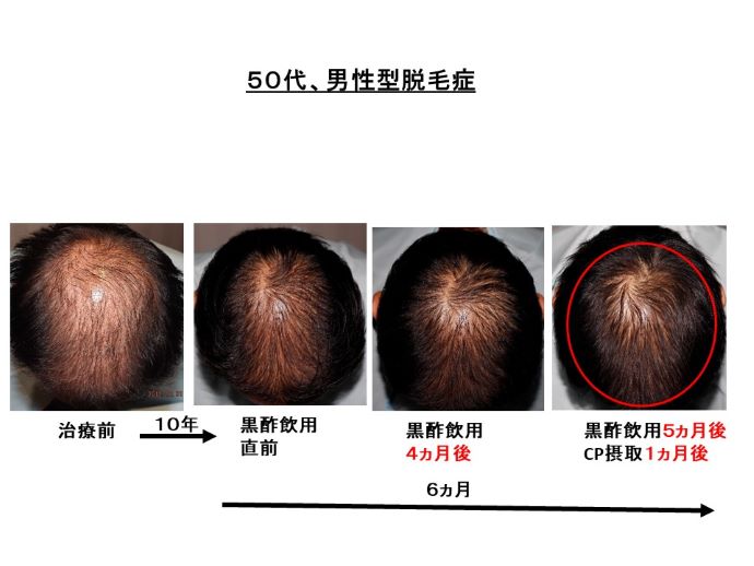 円形脱毛症　病院